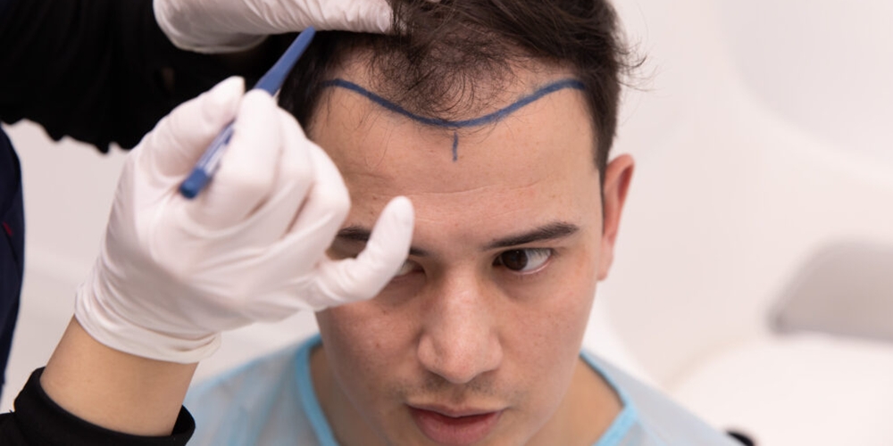 Rambut Menipis? Saatnya Mengenal Teknologi Hair Transplant Terbaru